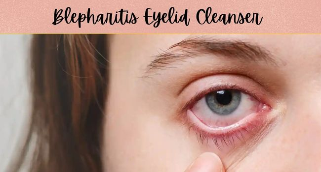 Blepharitis Eyelid Cleanser: Soothe Irritated Eyes & Restore Lasting Comfort